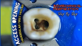 Access Opening Mandibular First Molar  Biomechanical Preparation  step by step [upl. by Nosahc431]