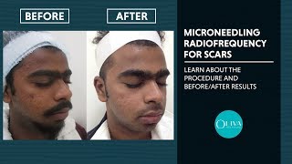 Microneedling RadiofrequencyRF Treatment Before And After Results  Oliva Clinic [upl. by Silado135]