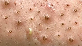 Great Blackhead Remover on Cheeks [upl. by Elaina]