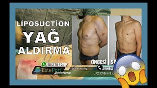 Liposuction Yağ Aldırma  Ameliyat Olmadan İzle [upl. by Ymmik]