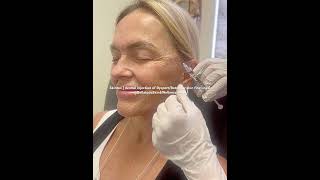 Skintox refers to the injection of Dysport or Botox into the dermis for skin fine lines [upl. by Luce]