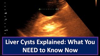 Liver Cysts Explained What You NEED to Know Now [upl. by Inami]