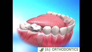 JampJ Orthodontics Molar Space Regainer Maintainer wwwjnjorthocom [upl. by Adekam]