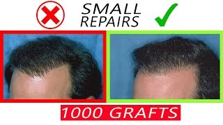 1000 graft Hair Transplant Repair Cases  Before and After [upl. by Eceined727]