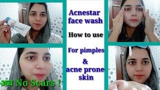 Acnestar Facewash how to use amp 100effective result  for pimples amp acneprone skin  Varda Mahak [upl. by Auoh382]