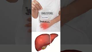 Gallstones Which Is the Most Common Type [upl. by Barclay]