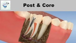 Post and Core After Root Canal Treatment [upl. by Varden]