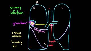 Primary and Secondary TB [upl. by Frick]