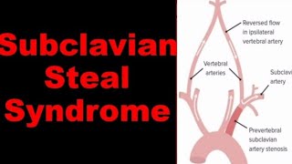 How to assess Subclavian steal syndrome by Ultrasound [upl. by Peedus14]