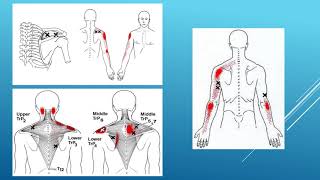 Myofascial pain management and trigger point therapy  Michalis Charalampidis [upl. by Moynahan179]