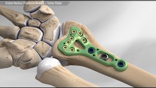 Distal Radius Fracture Repair  Volar Plate [upl. by Bianchi929]