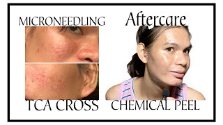 Aftercare  TCA CROSS  CHEMICAL PEEL  MICRONEEDLING youtube diy banishacnescars [upl. by Graehme]