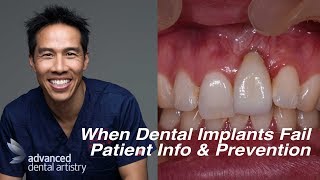 Dental Implant Failures  Patient Information and Prevention [upl. by Laurette169]