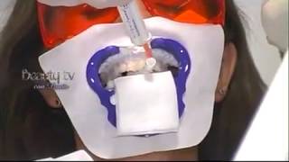 Estetica dental implantes Bicon carillas Lumineers blanqueamiento BriteSmile [upl. by Leehar]