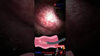 Coloscopy  Colon Polyp Resection  Polypectomy [upl. by Casper]