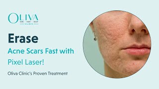 Erase Acne Scars Fast with Pixel Laser  Oliva Clinic’s Proven Treatment [upl. by Conard524]