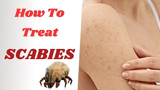 How To Treat Scabies Effectively  From PERMETHRIN Cream To IVERMECTIN Tablets [upl. by Ahsienom211]