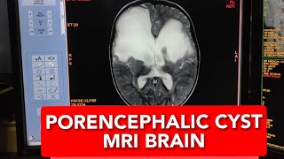 How to Read MRI Brain of 2 years Baby Diagnosing Large Porencephalic Cysts in English [upl. by Aerdnahs40]