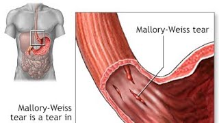 Mallory weiss syndromeEsophagus fissure [upl. by Aicela621]