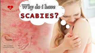 Scabies mites coming out of my skin [upl. by Celik]