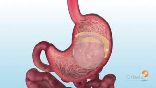 ORBERA Animation  Gastric Balloon [upl. by Ansela819]