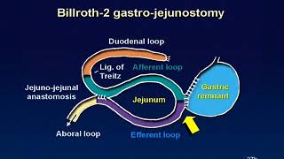 01 Billroth 2 reconstruction animation [upl. by Noeled552]