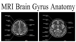 MRI Brain Gyrus Anatomy [upl. by Bernarr]