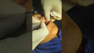 Oral fibroma removal with CO2 Laser [upl. by Champagne]