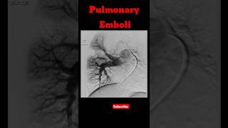 Pulmonary Emboli shorts pulmonaryembolism radiology pulmonarydisease [upl. by Elke]