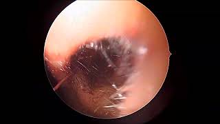 Unedited part 3 endoscopic septal correction spurectomy [upl. by Adnuahsor6]