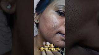 Day19 Using Tretinoin 0025 cream viralvideo tretinoin youtubeshorts skincare shorts [upl. by Eilis73]