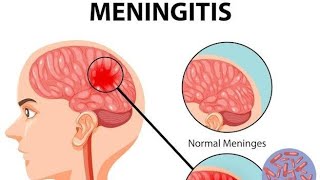 Meningitis  Part 1  Pathology  Harsh Mohan  Notes  Easy Explanation [upl. by Charis]