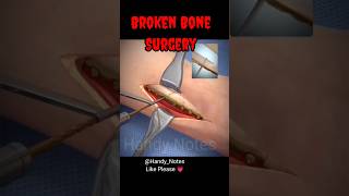 leg Broken Bone Surgery surgeryday anatomy physiology [upl. by Paviour786]