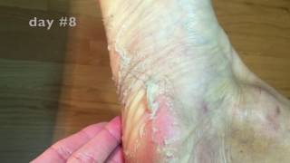 PATCHOLOGY POSHPEEL PEDI CURE EXFOLIATING FOOT PEEL DEMO [upl. by Anirahtak]