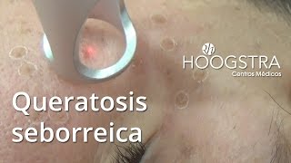 Queratosis seborreica 15163 [upl. by Jacobba118]