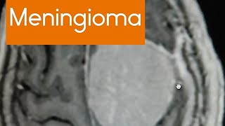 Meningioma most common tumour of the menings  on MRI  radiology mri brain learning case [upl. by Ecnaiva]