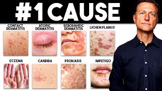 The MOST Common Deficiency in All Skin Diseases Dermatitis [upl. by Assillem389]