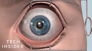 Lasik Laser Eye Surgery Procedure  Live Surgery [upl. by Ayhdnas314]