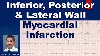 Inferior Posterior and Lateral Wall Myocardial Infarction [upl. by Ijuy]