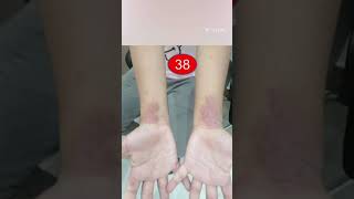 InteractiveDermatology clinic Cases 37 Koilonychia amp 38 Atopic dermatitis [upl. by Standush]