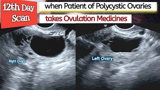 Ovarian CYSTS  Ovulation Medicines in PCOS Patient  Polycystic Ovaries  Infertility [upl. by Aes]