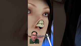 How to do Rhinoplasty greenscreen youtubeshorts viralvideo shorts [upl. by Accissej296]