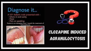 A side effect of clozapine  Agranulocytosis [upl. by Basir]