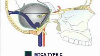 PETROCLIVAL MENINGIOMA DECISION MAKING [upl. by Erinn]