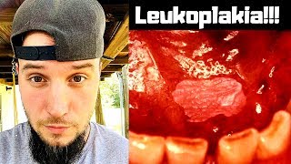 Dangers of Dipping 1 Leukoplakia [upl. by Meridel]