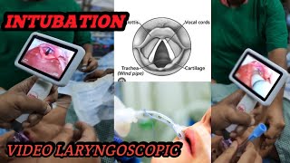 HOW TO DO VIDEO LARYNGOSCOPIC FOR TRACHEAL INTUBATION INSERT ET TUBEBENGALI LANGUAGE [upl. by Ivel883]