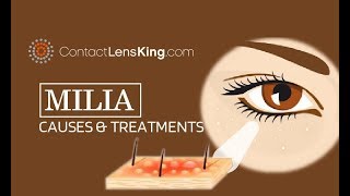 Milia Extraction Causes and Treatment  Milia Under the Eyes [upl. by Etyak]