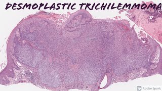 Desmoplastic Trichilemmoma 101 [upl. by Avonasac76]