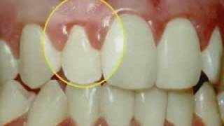 Periodontal Disease amp Treatment [upl. by Oal]