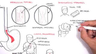 GORD GERD Gastro Oesophageal Reflux Disease  Overview pathophysiology treatment [upl. by Fermin]